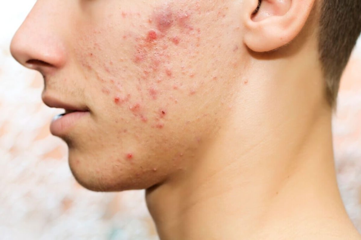Understanding Acne Causes